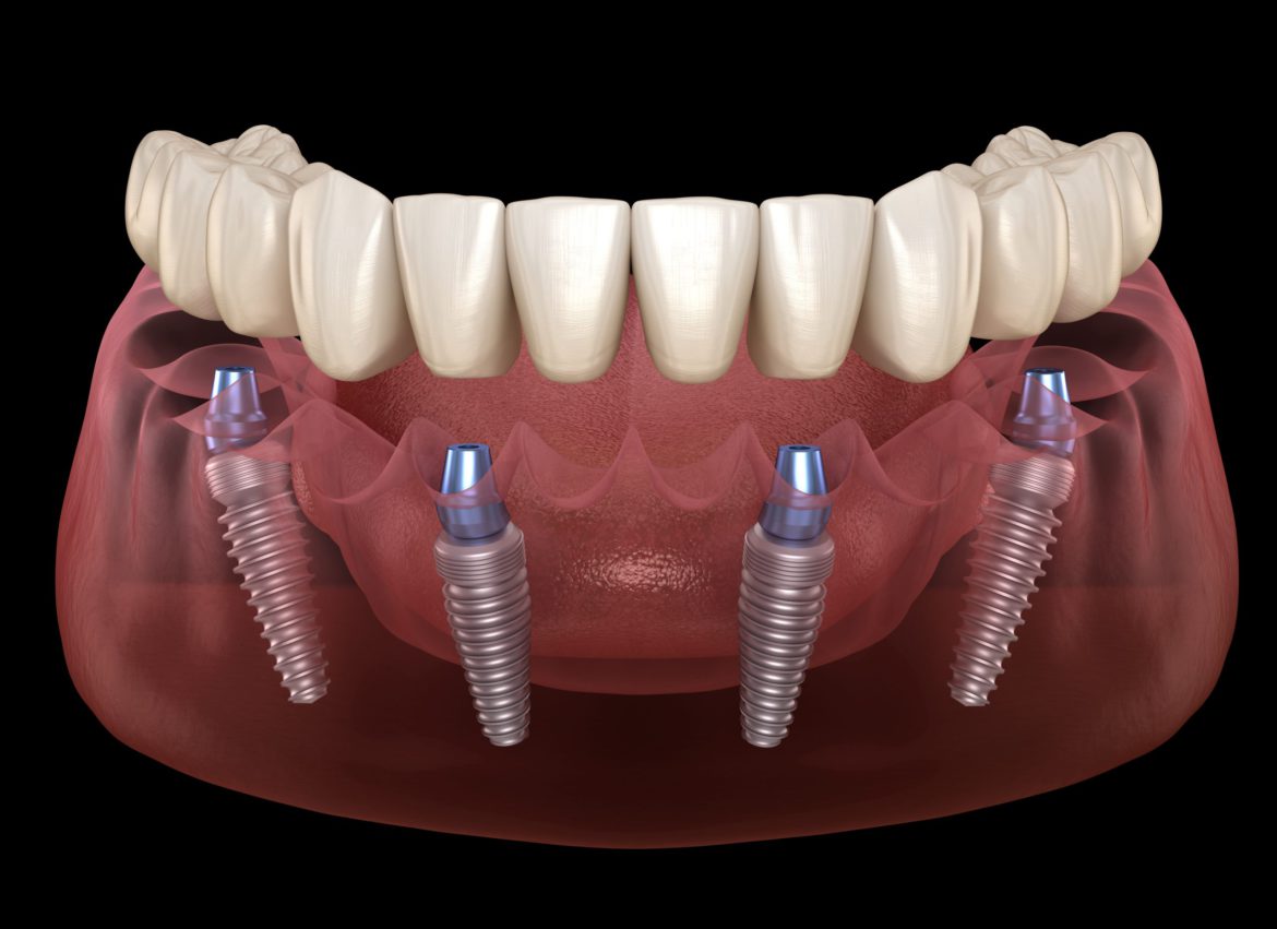 Unveiling the Innovation: Endosteal Dental Implants in Drexel Hill, PA
